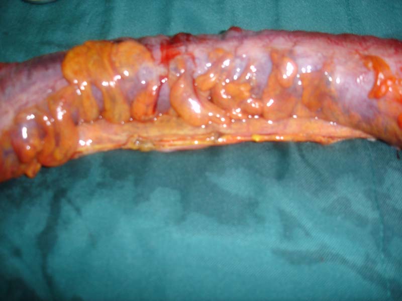 ulcerative colitis disease  